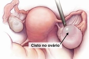 Arquivos Cistos de Ovários - Scope Ginecologia