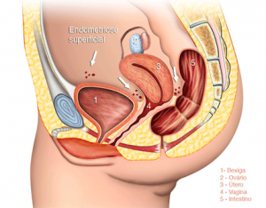 Endometriose