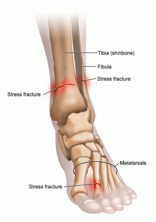 Fratura por Estresse