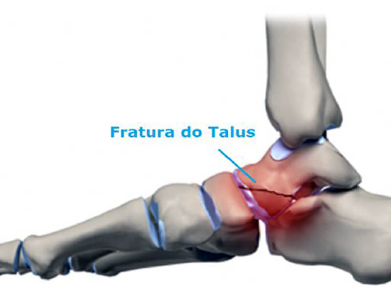 Ortopedia - Fratura de Talus