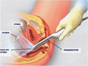Ultrassonografia Transvaginal